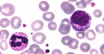 PARLA LUCANO LA RICERCA SULLA LEUCEMIA